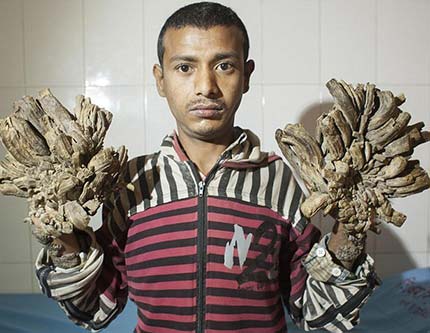 В Бангладеше прооперируют мужчину, у которого кисти рук превратились в «дерево»